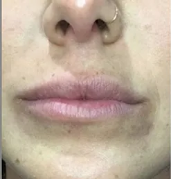 Lip augmentation Before and After Results