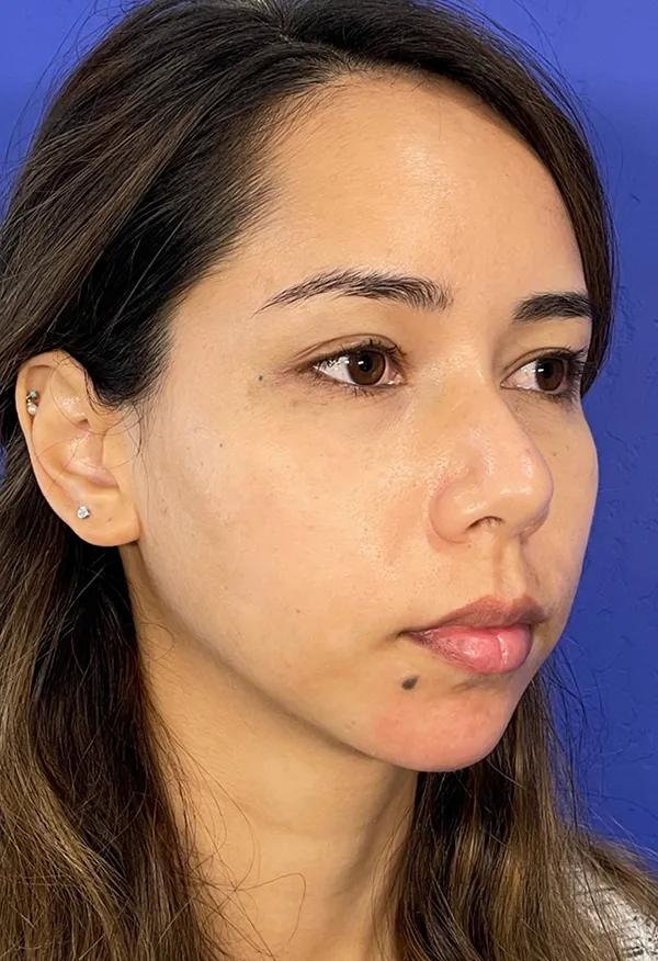 Chin Filler Before and After Results