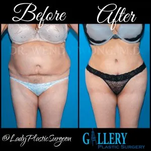 Photo Gallery before and afters before  surgery