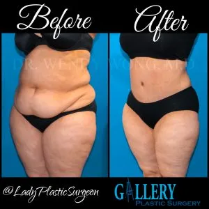 Photo Gallery before and afters before  surgery