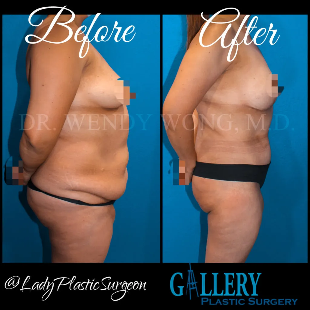 Photo Gallery before and afters before surgery