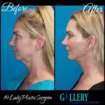 Photo Gallery before and afters before surgery