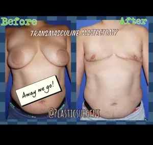 Gender Affirmation Surgery (Top Surgery) image